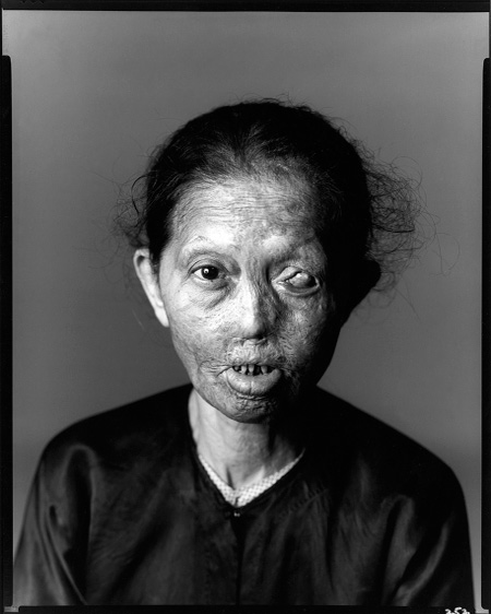 Richard Avedon. 'Napalm Victim #1, Saigon, South Vietnam, April 29, 1971' 1971
