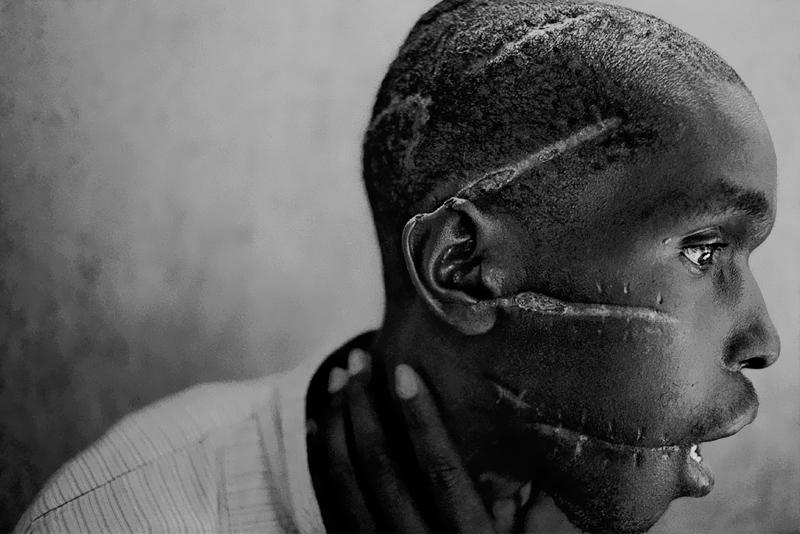 James Nachtwey. 'A Hutu man who did not support the genocide had been imprisoned in the concentration camp, was starved and attacked with machetes. He managed to survive after he was freed and was placed in the care of the Red Cross, Rwanda, 1994' 1994