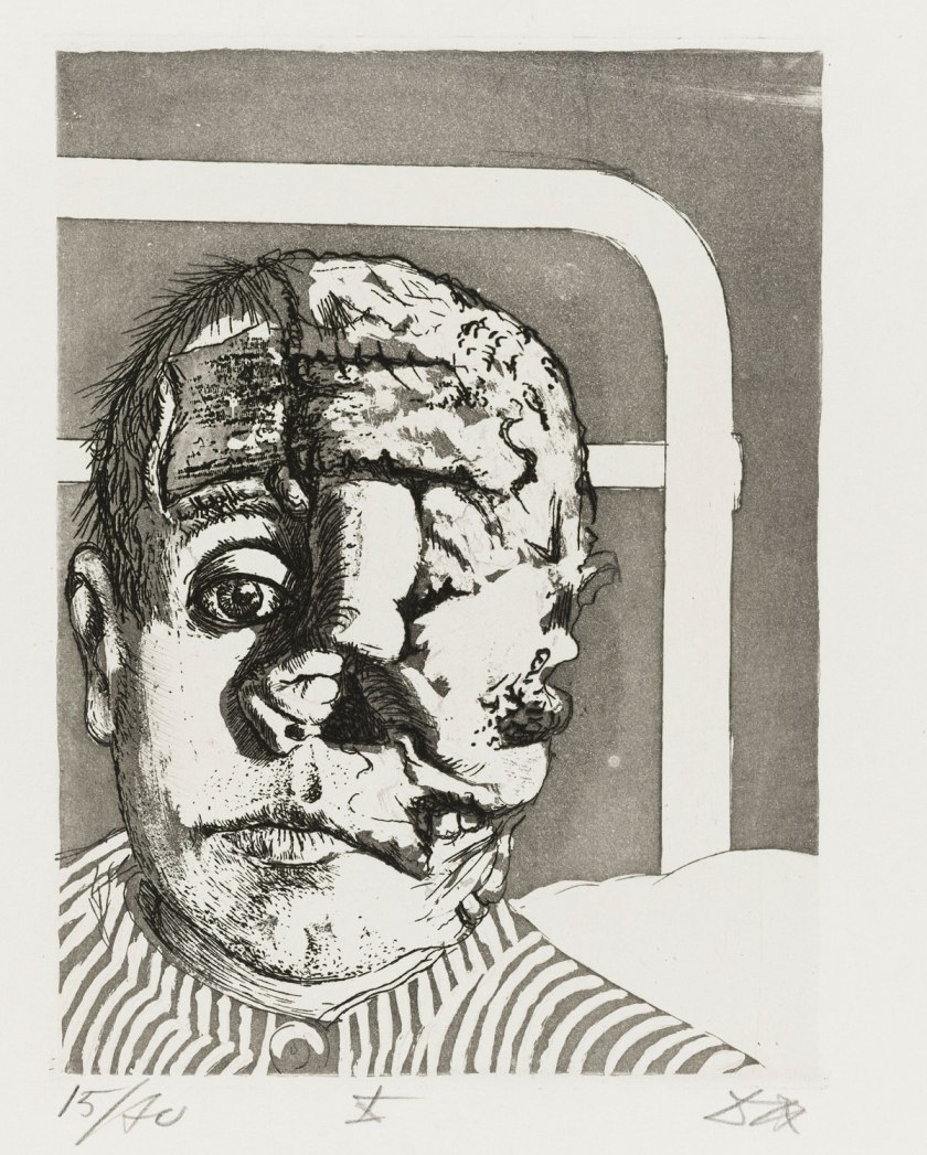 Otto Dix Skin Graft (Transplantation) from the portfolio War (Der Krieg), 1924