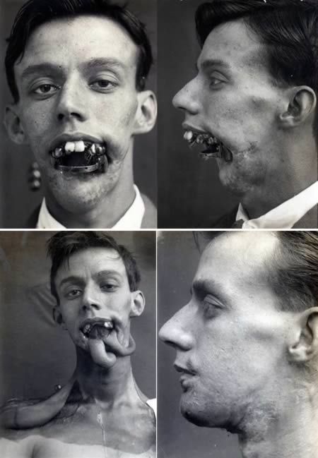 Facial reconstruction WW1. Willie Vicarage, suffering facial wounds in the Battle of Jutland 1916 Naval Battle was one of the first men to receive facial reconstruction using plastic surgery