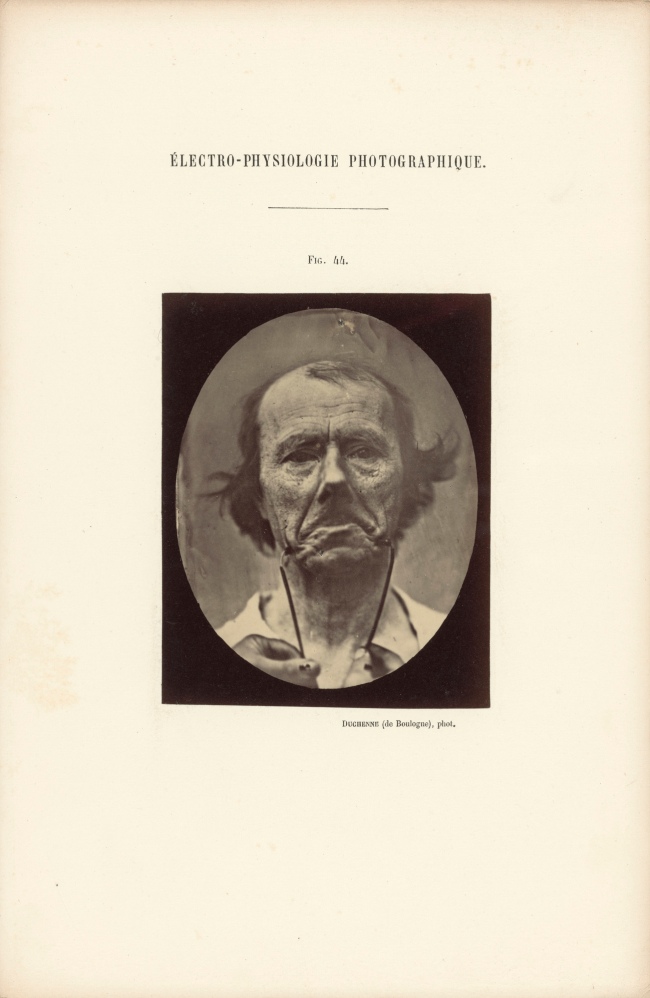 Guillaume-Benjamin Duchenne (French, 1806-1875) 'Figure 44, The Muscle of Sadness' Negative 1854-1856; print 1876