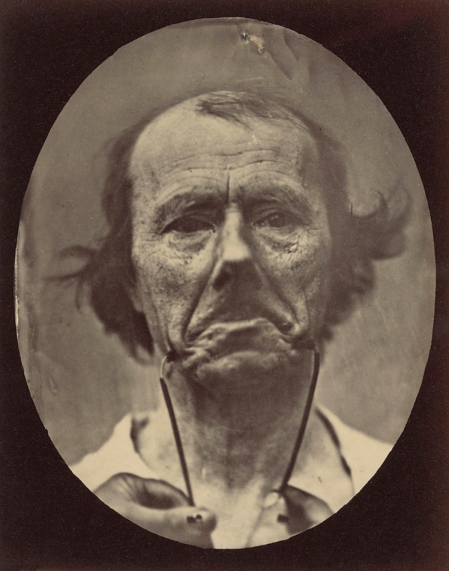 Guillaume-Benjamin Duchenne (French, 1806-1875) 'Figure 44, The Muscle of Sadness' Negative 1854-1856; print 1876 (detail)